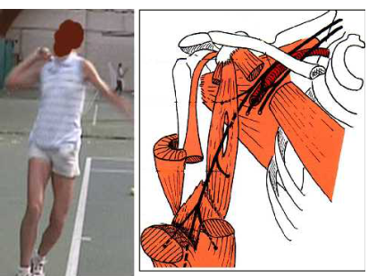 Cours anatomie 1ere année medecine: Nerf médian et musculocutané 47 Cours-gratuit-Compression du nerf lors de la pratique sportive 1
