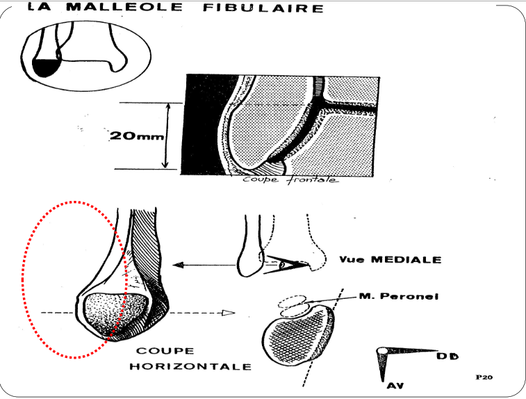 Cours anatomie 1ere année medecine : Articulation talo-crurale 9 Cours-gratuit-la malleolle fabilure