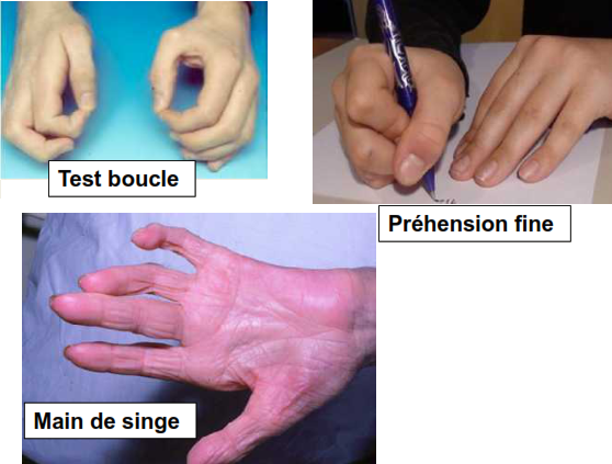 Cours anatomie 1ere année medecine: Nerf médian et musculocutané 31 Cours-gratuit-main de singe