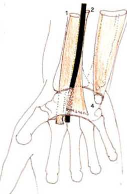 Cours anatomie 1ere année medecine: Nerf médian et musculocutané 9 Cours-gratuit-muscles flechisseur radial du carpe