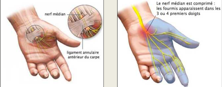 Cours anatomie 1ere année medecine: Nerf médian et musculocutané 19 Cours-gratuit-nerf median Le syndrome du canal carpien 1