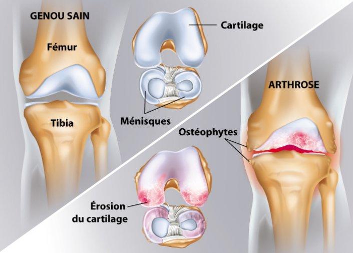 Arthrose du genou