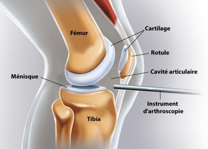 Arthroscopie du genou